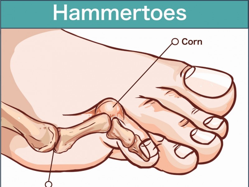How to Avoid Unsightly, Painful Hammertoe