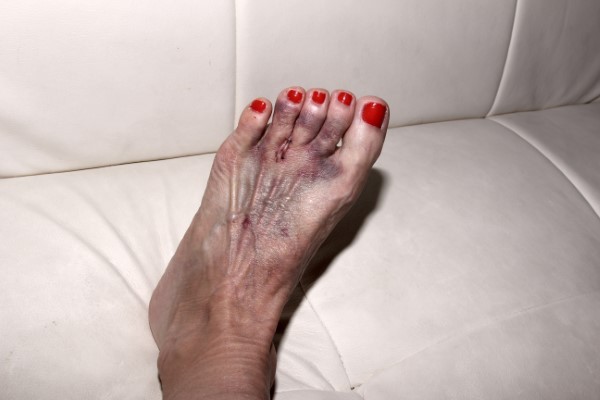 Wearing High Heels Can be Bad for Your Feet