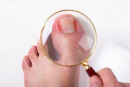 Ingrown Toenails: Why You Need to See a Podiatrist