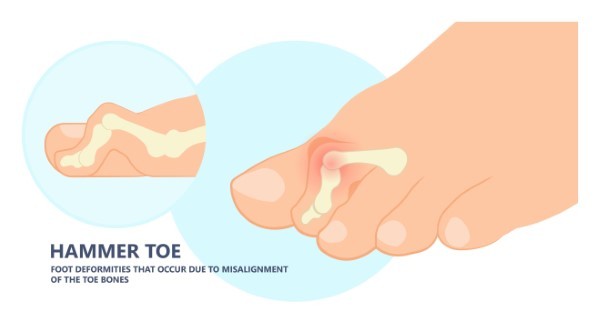 Could That Odd Bend in Your Toe Be A Hammertoe? Ask A Podiatrist