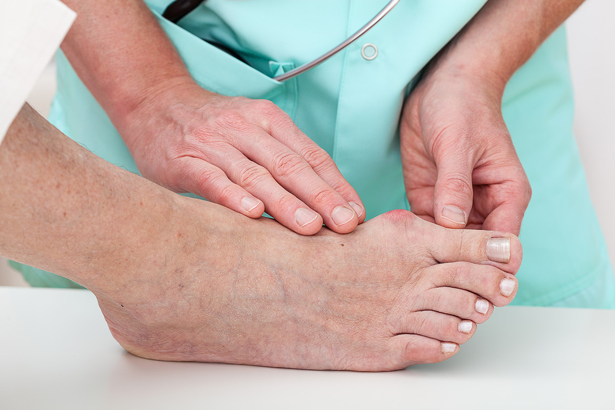 Bunions | Brooklyn and Queens NY | Metropolitan Foot Care