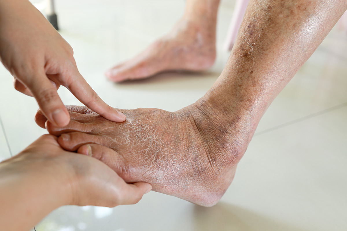 Diabetic Foot Care | Brooklyn and Queens NY | Metropolitan Foot Care