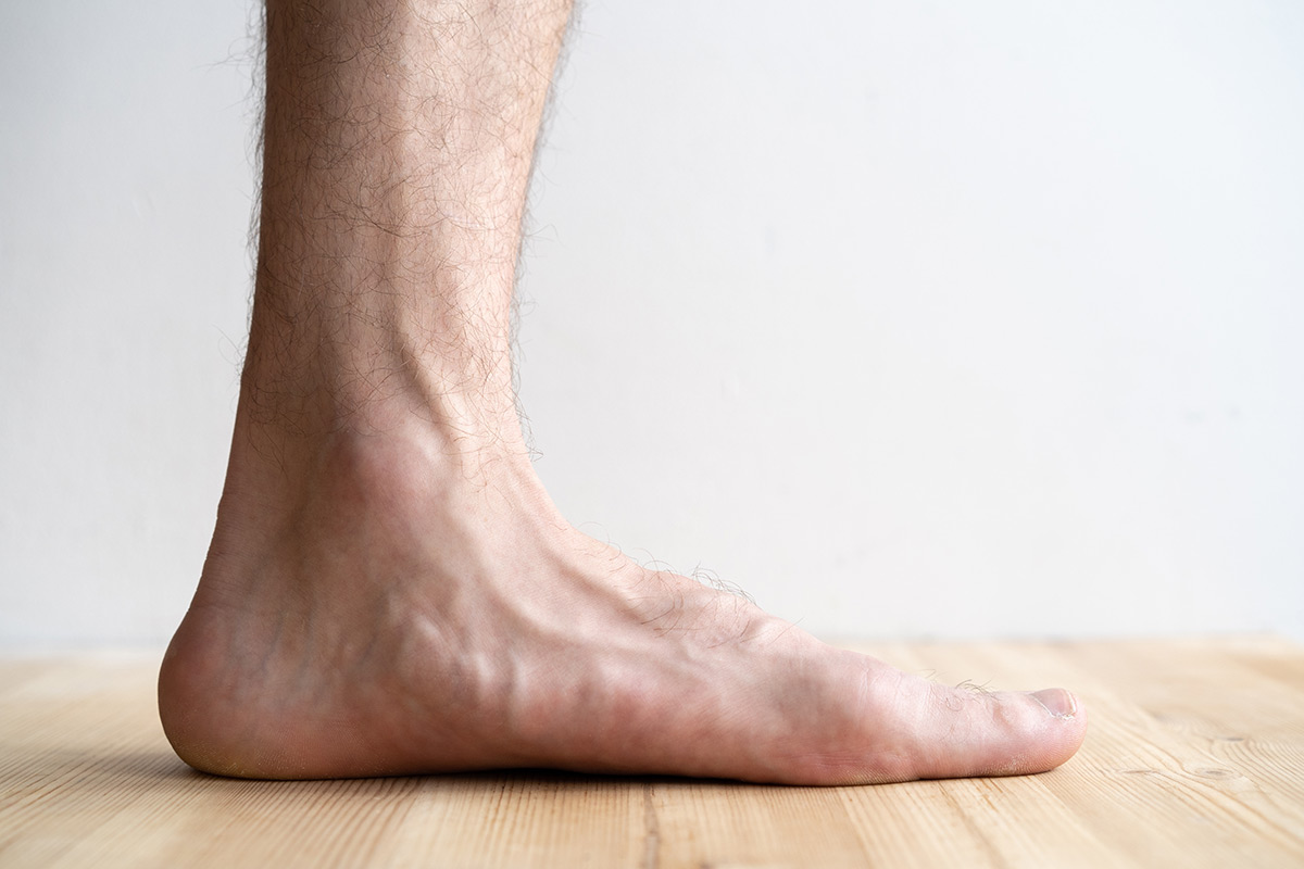 Flat Feet | Brooklyn and Queens NY | Metropolitan Foot Care