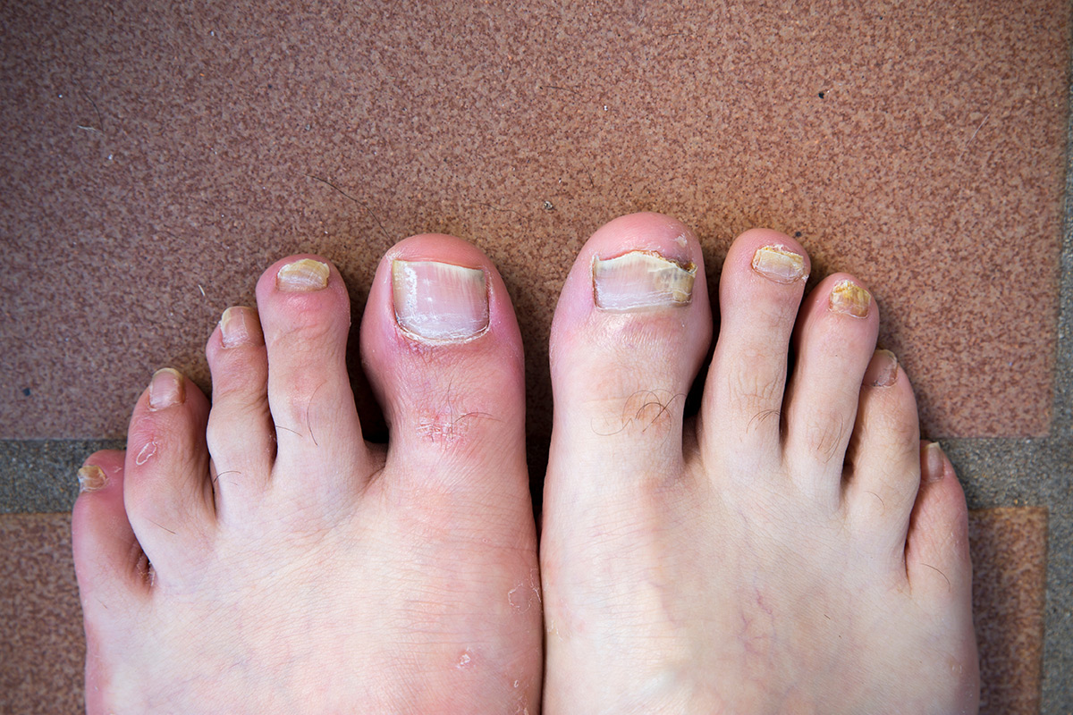Fungal Infection | Brooklyn and Queens NY | Metropolitan Foot Care