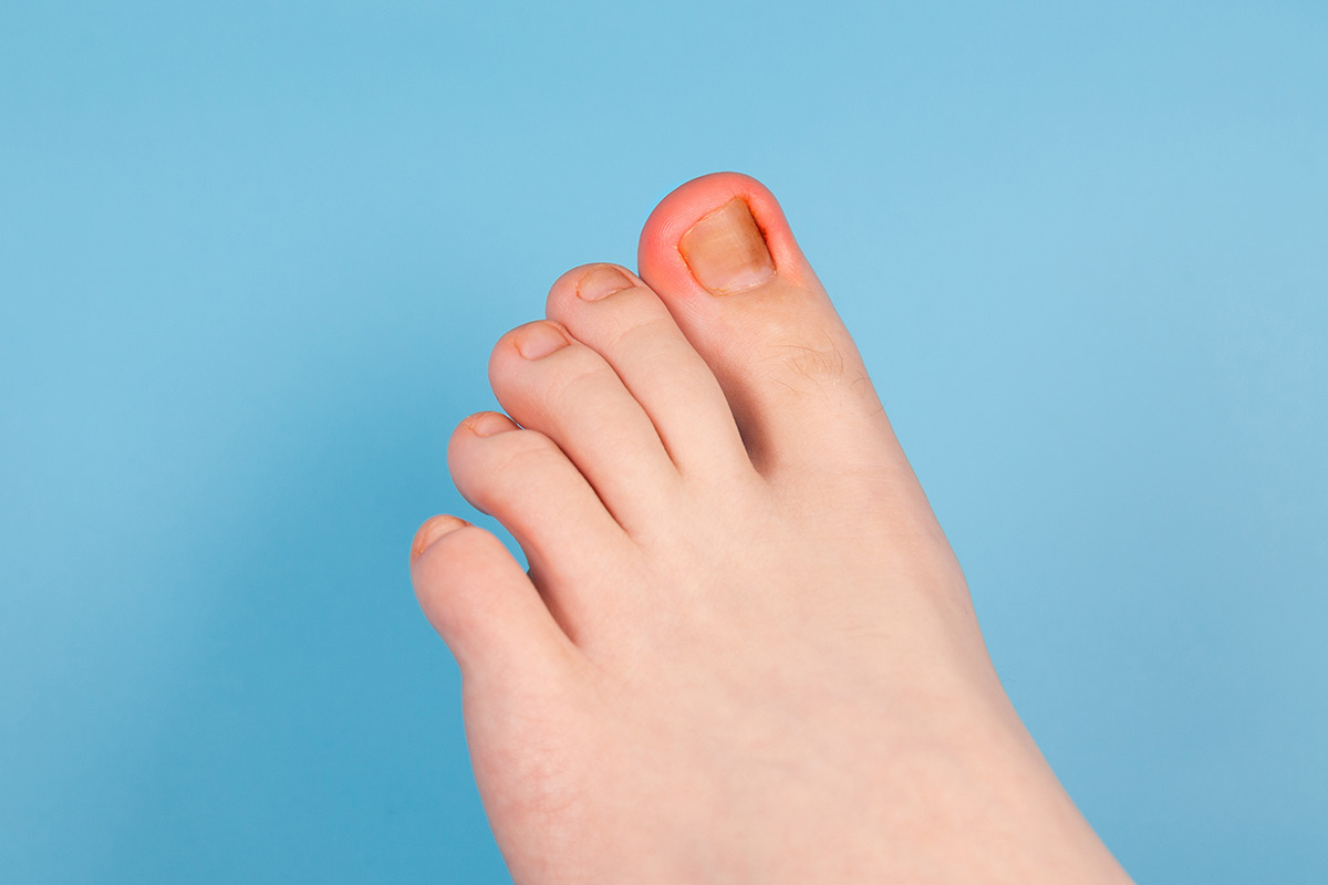 Ingrown Nails | Brooklyn and Queens NY | Metropolitan Foot Care