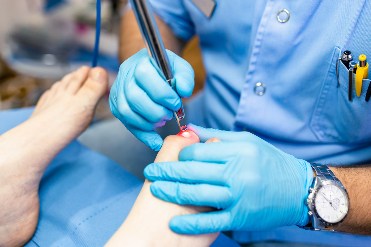 Laser treatment for Toenail Fungus in Woodside, Queens NY